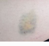 Name:  Bruise Pic 1.jpg
Views: 144
Size:  4.0 KB