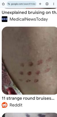Name:  Bruise Pic 2.jpg
Views: 148
Size:  14.5 KB