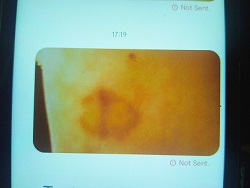 Name:  bruise on inner arm.jpg
Views: 135
Size:  15.6 KB